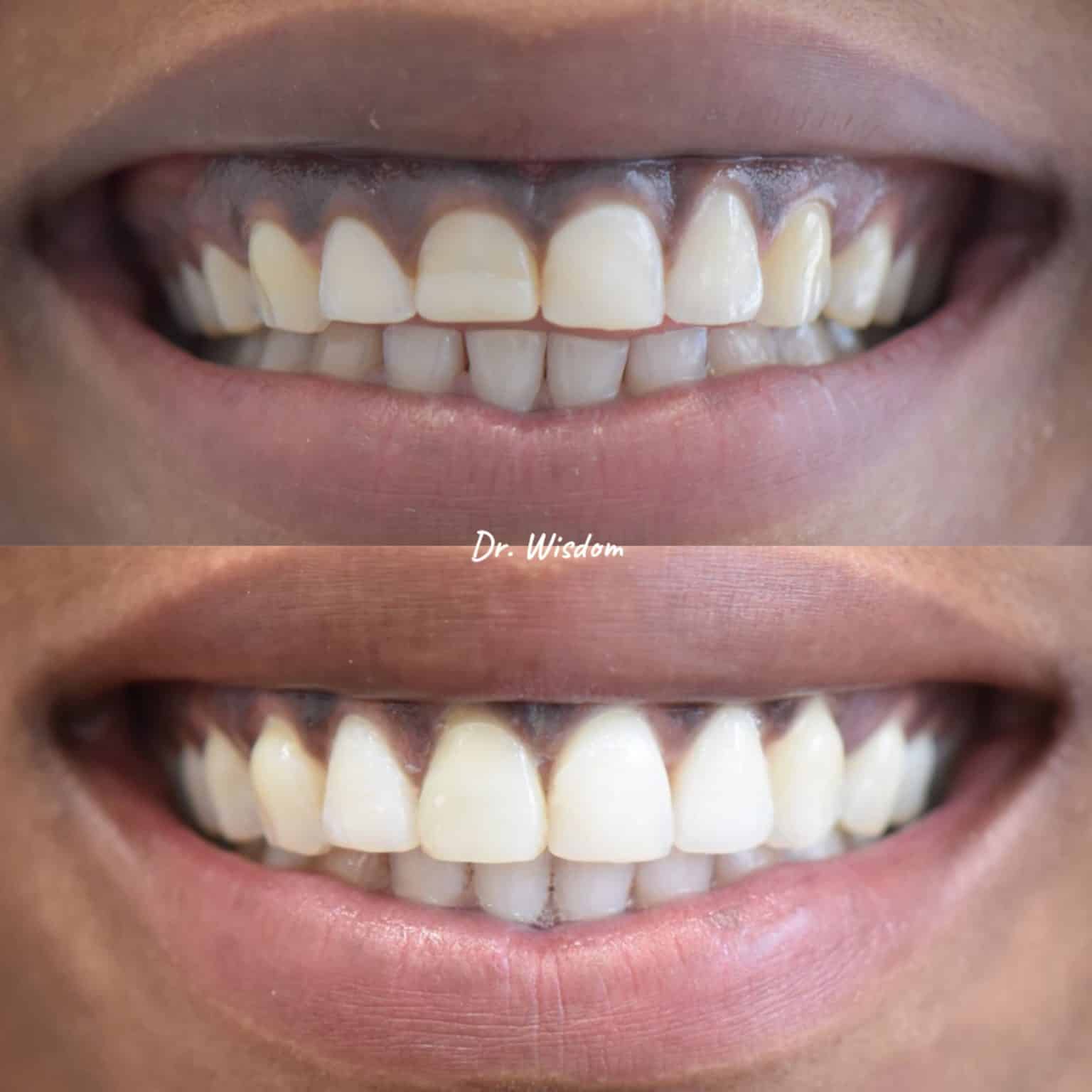 Before and After: Gum Contouring